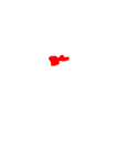 척추측만증