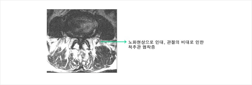 척추 뼈