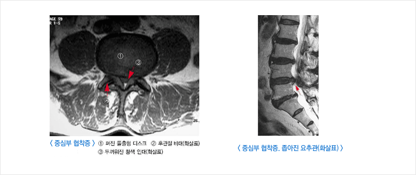 척추 뼈