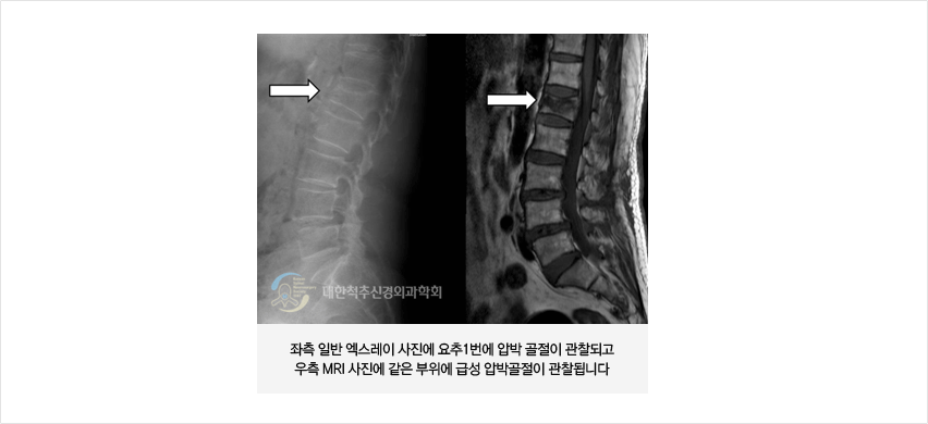 척추 뼈