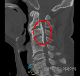 척추 뼈