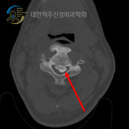 척추 뼈