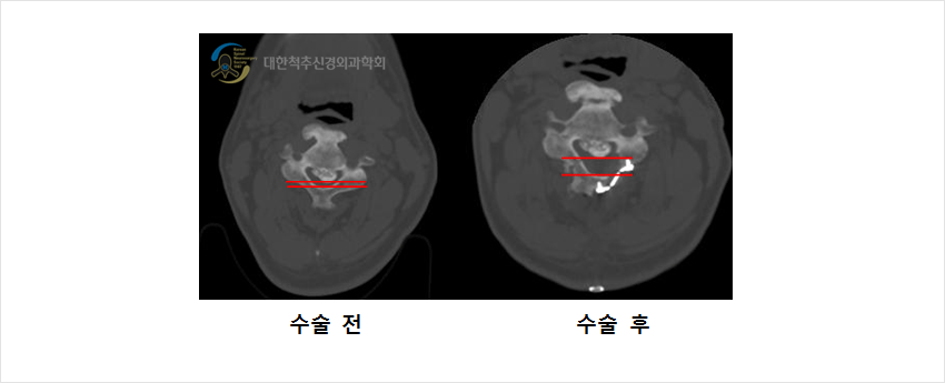 척추 뼈